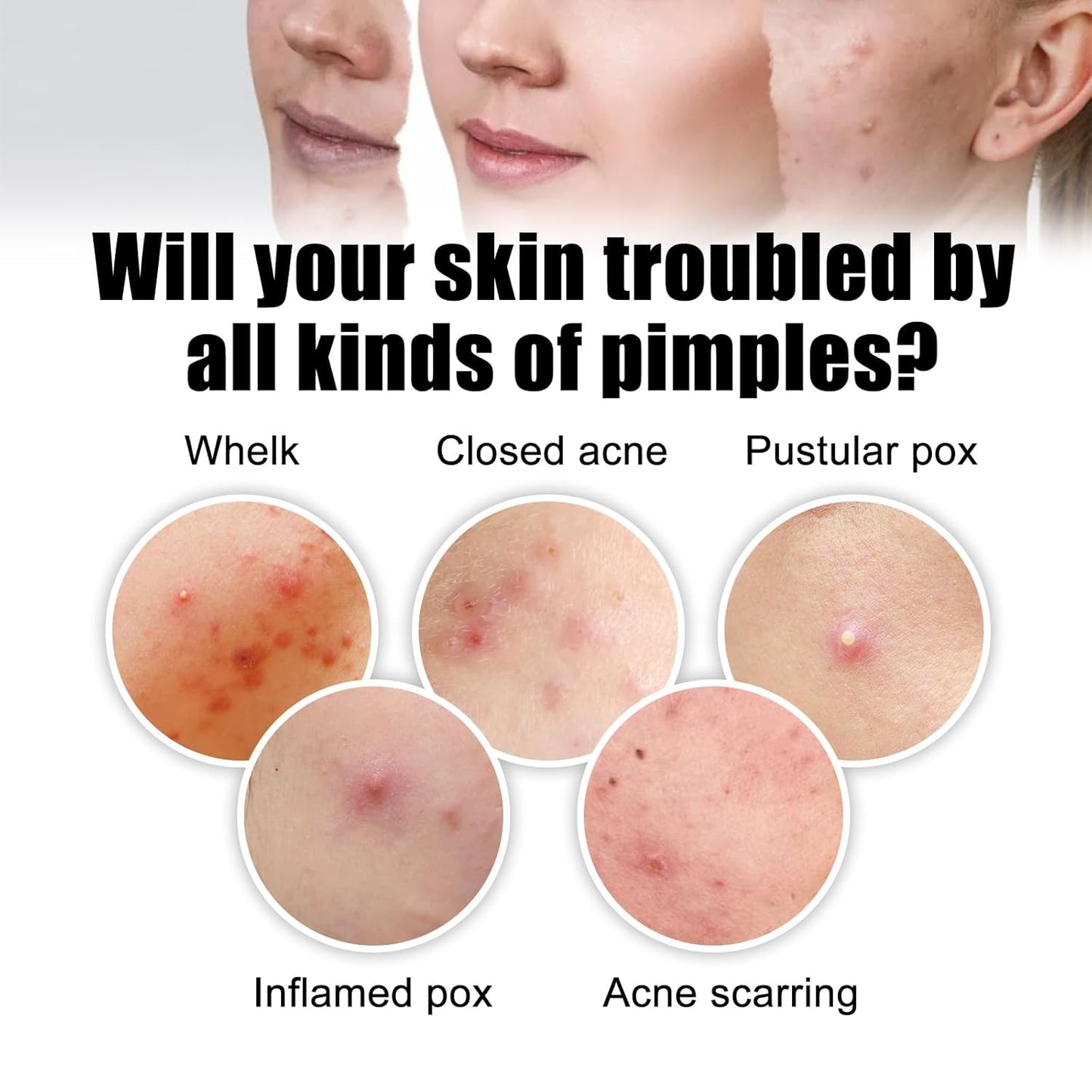 60 Pcs Hydrocolloid Pimple Patches with Tea Tree — Star & Flower Acne Stickers