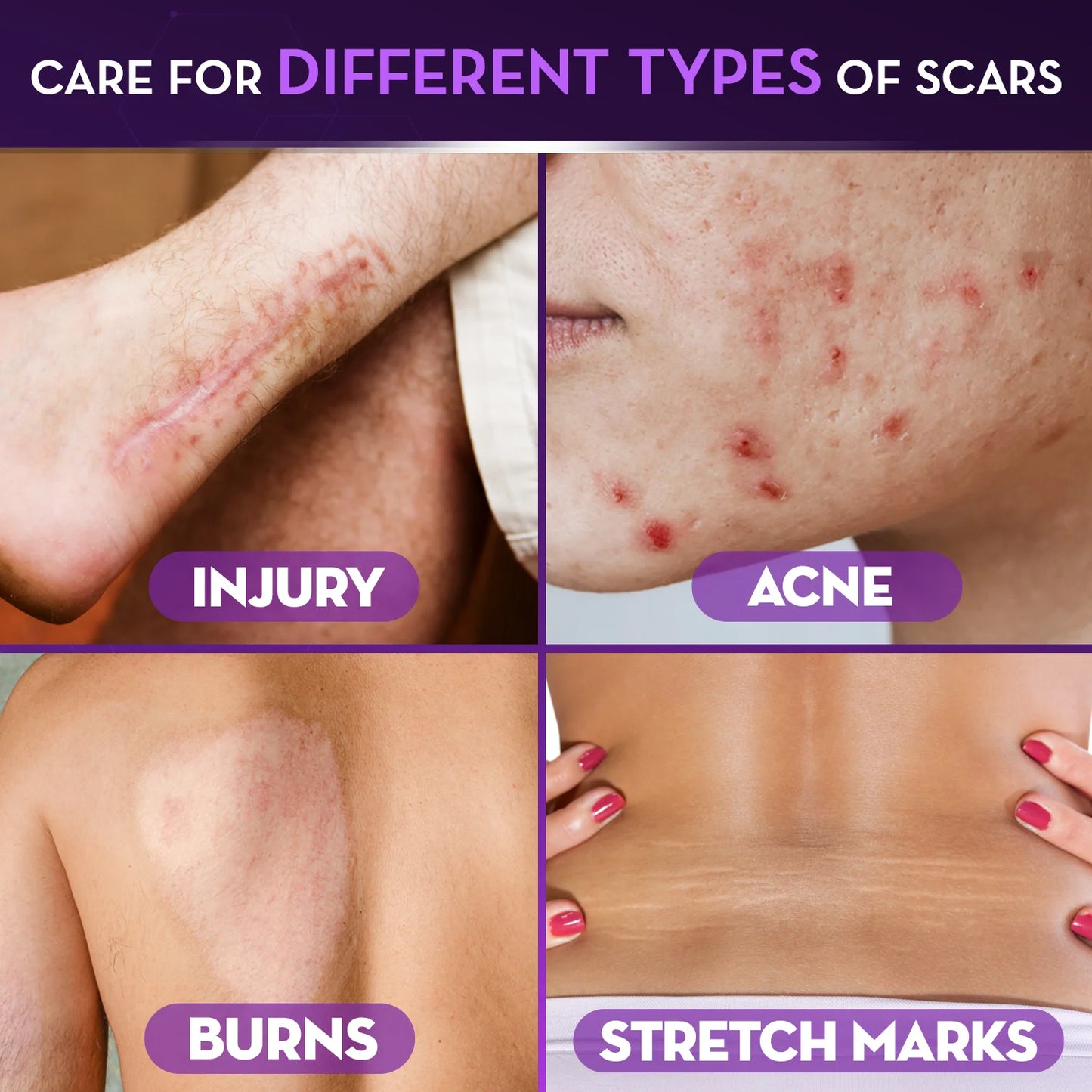 Scar Reducing Cream, Face & Body Scar Gel, 1 Oz