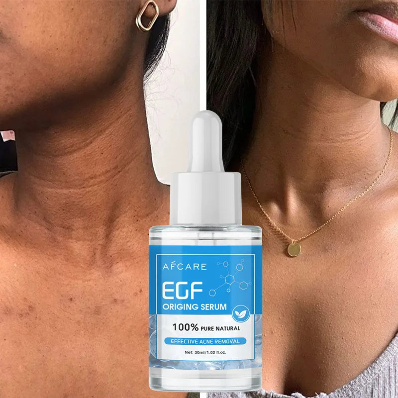 Zynerae EGF Acne Treatment Serum – Clears Acne and Repairs Skin.