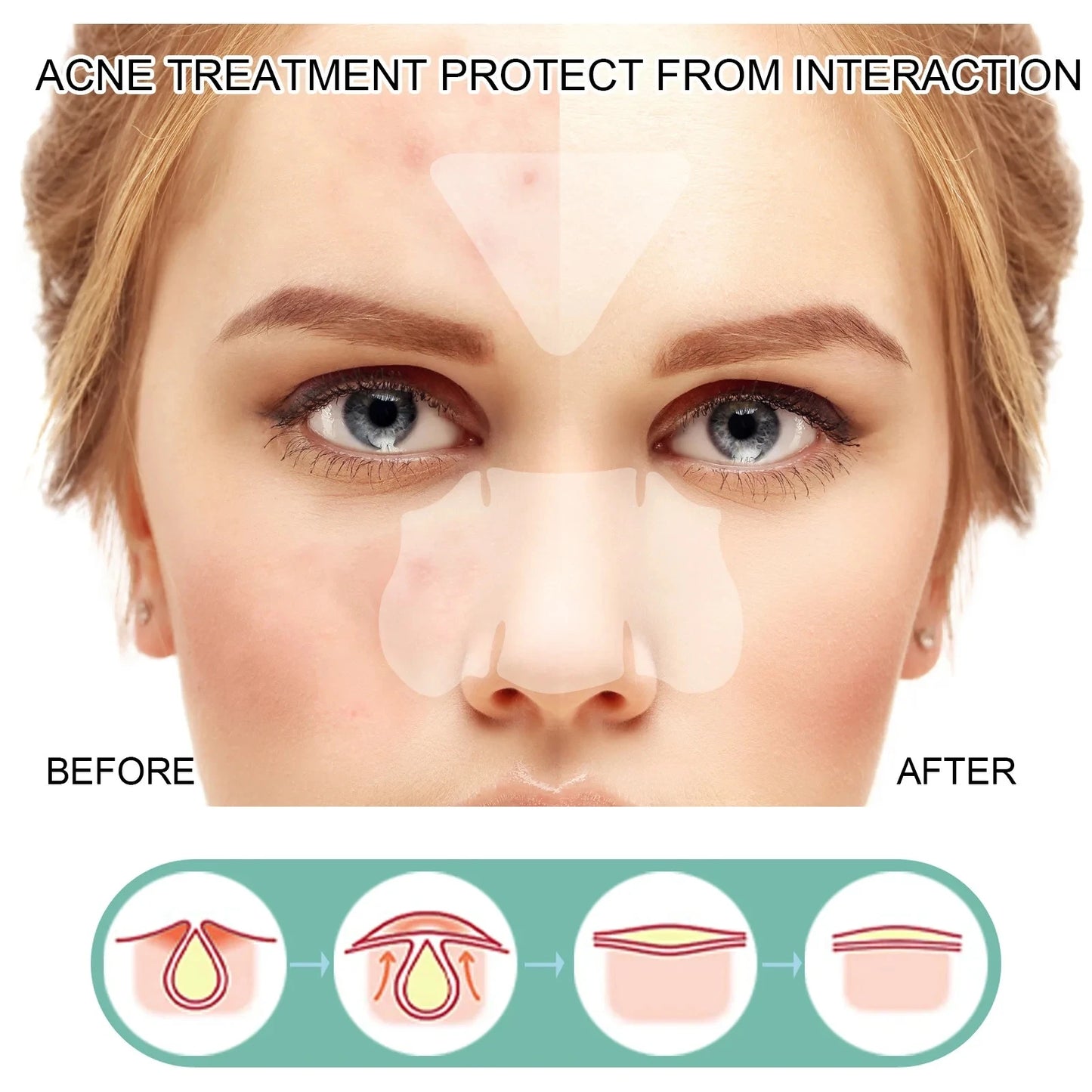 132 Pcs Hydrocolloid Acne Pimple Patches — Invisible Spot Stickers for Face