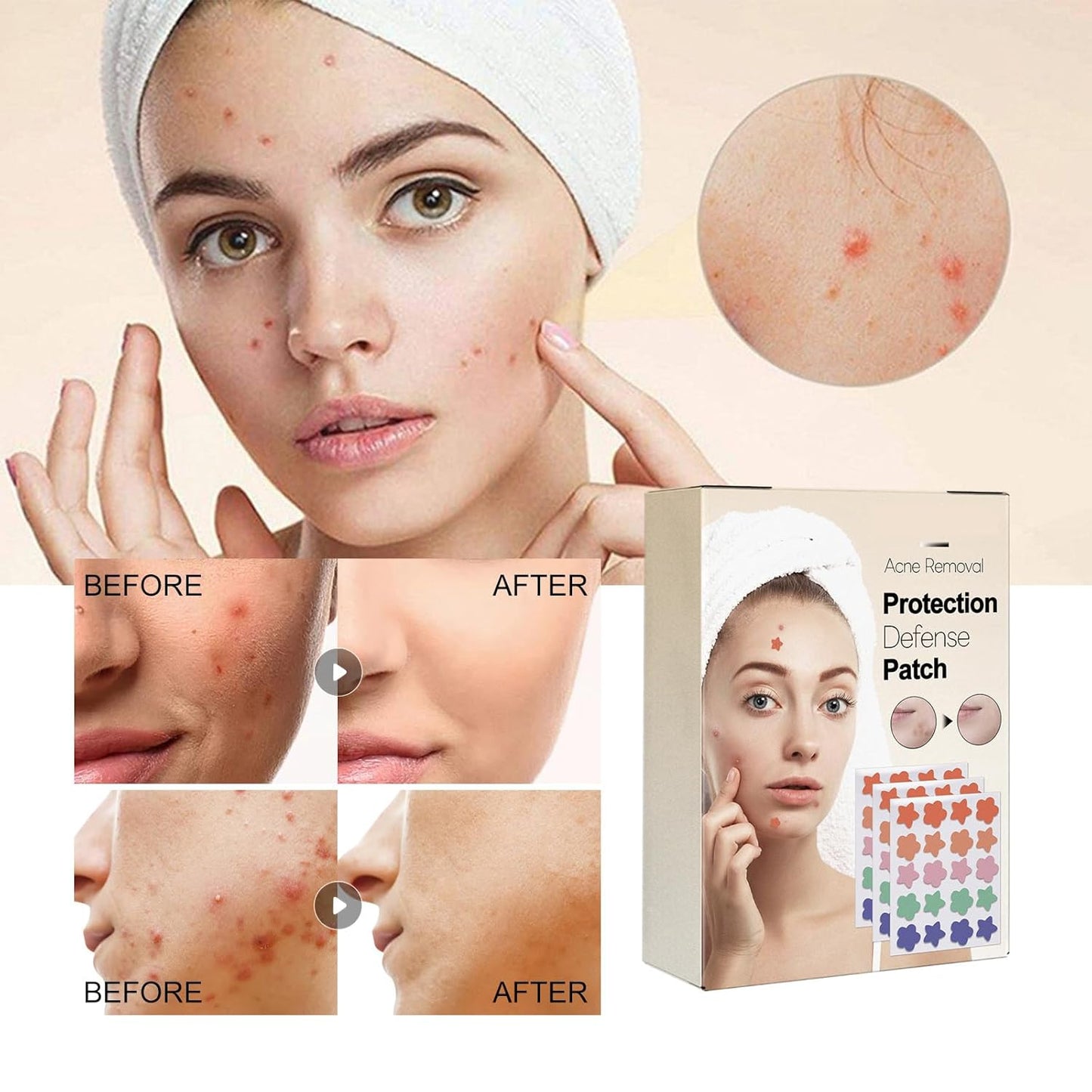 60 Pcs Hydrocolloid Pimple Patches with Tea Tree — Star & Flower Acne Stickers