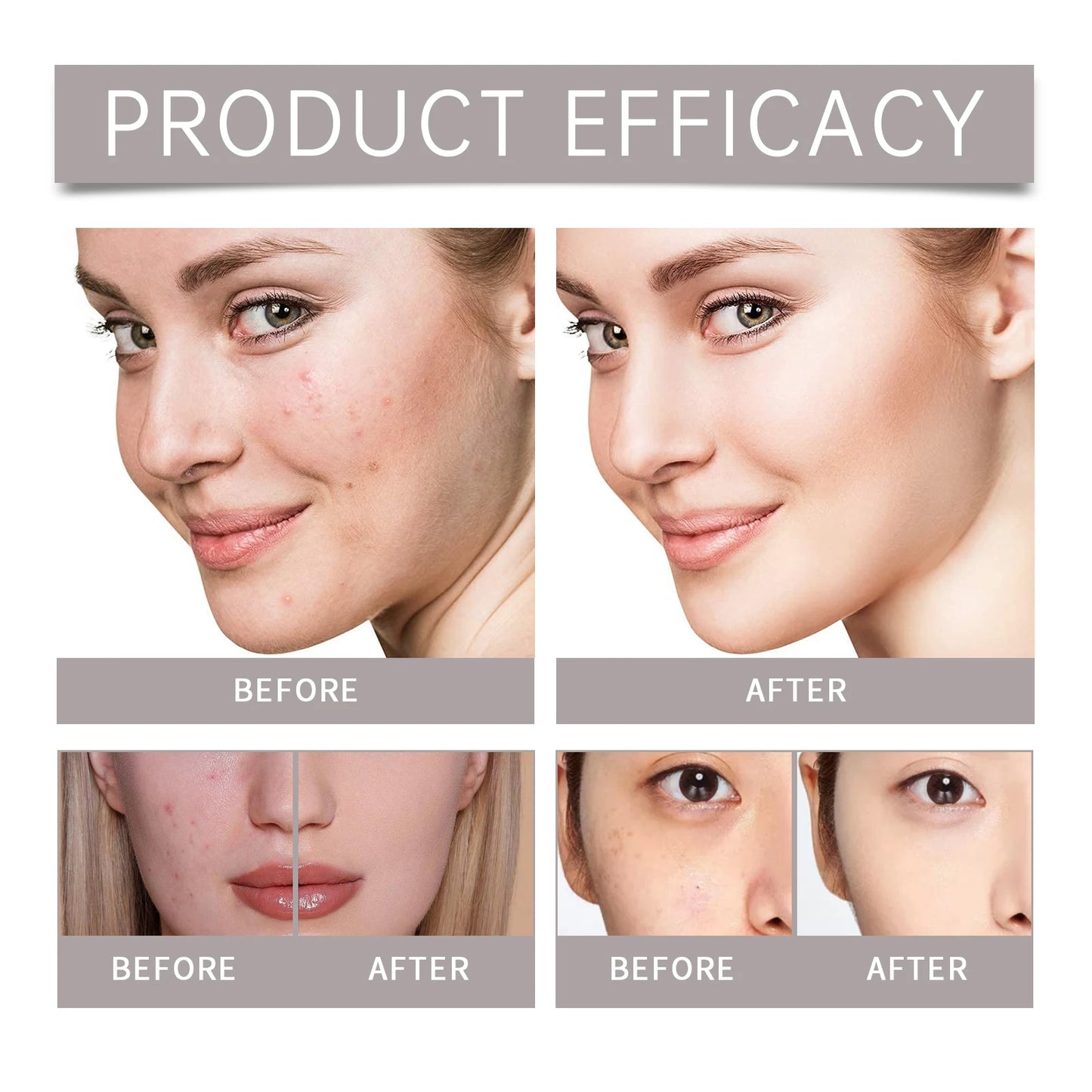 Acne Care Kit Brightening Skin Tone Fade Acne Scars Improving Skin Texture Deeply Moisturizing the Skin Facial Skincare Products