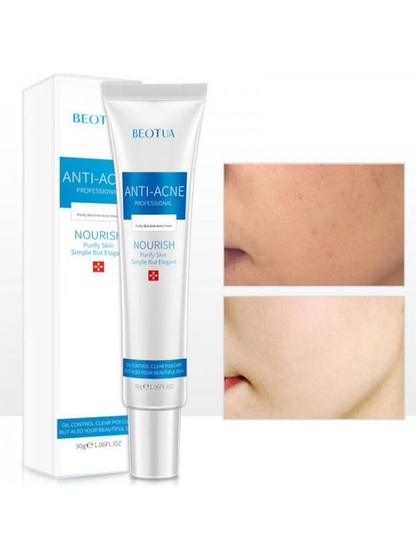 Acne Cream 20g – Natural Gel for Face, 2PCS.