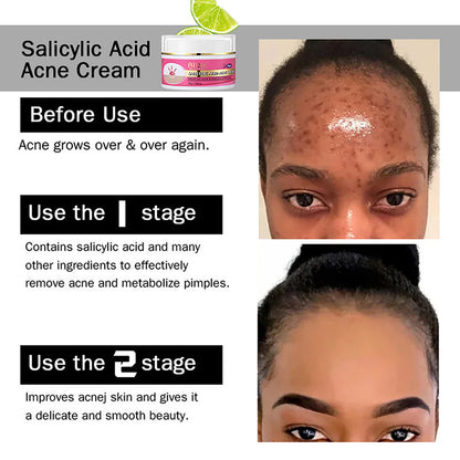 AILKE Acne Removal Face Cream – Brighten and Clear, Radiant Skin.