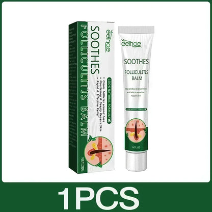 Zynerae Anti-Acne Cream – Removes Pimples, Cysts and Blackheads.