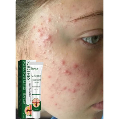 Zynerae Anti-Acne Cream – Removes Pimples, Cysts and Blackheads.