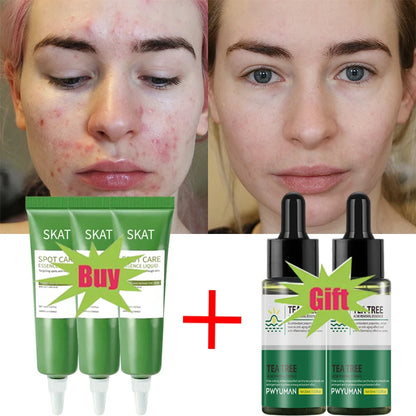 Zynerae Salicylic Acid Acne Cream – Pimple Spot and Scar Treatment.