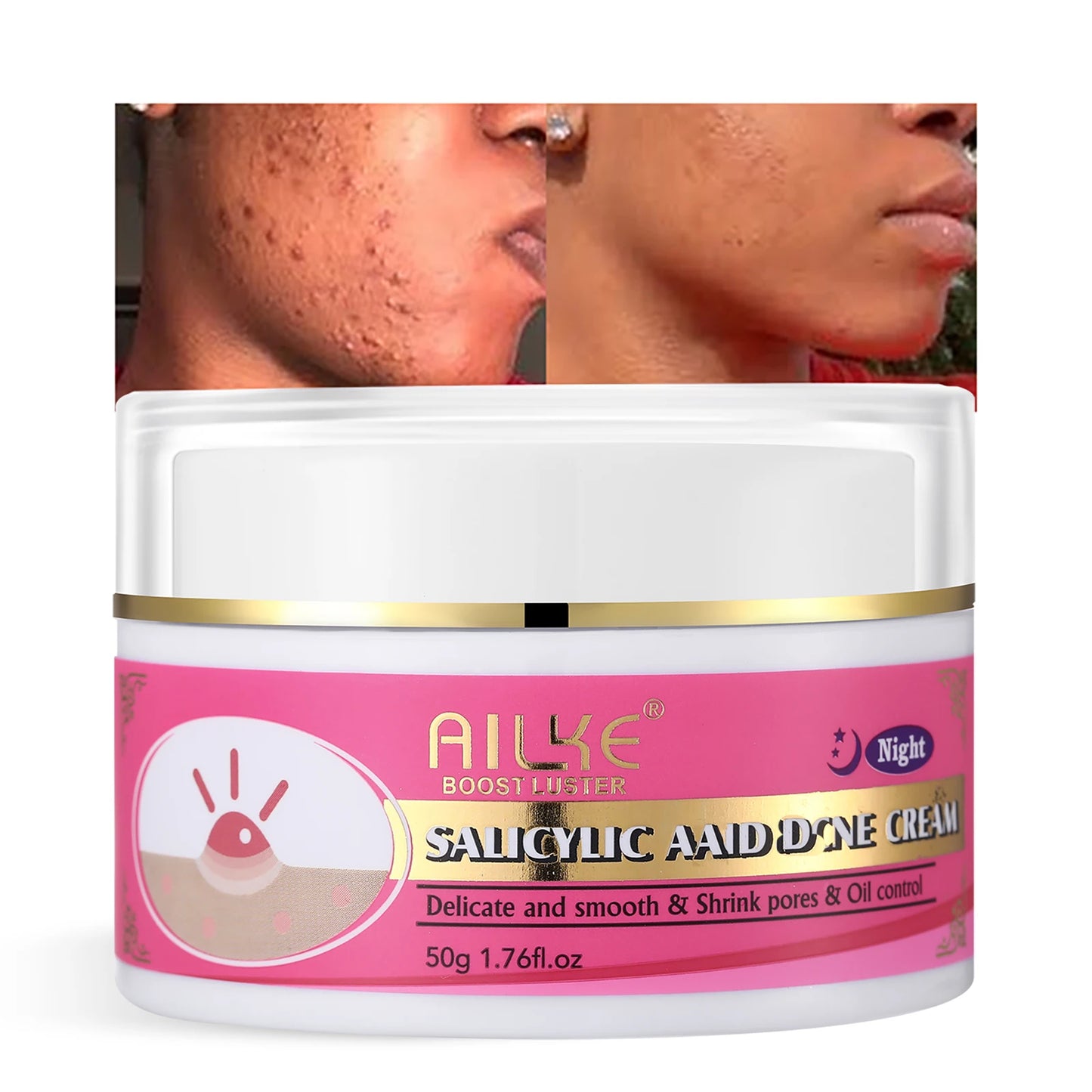 AILKE Acne Removal Face Cream – Brighten & Clear Skin