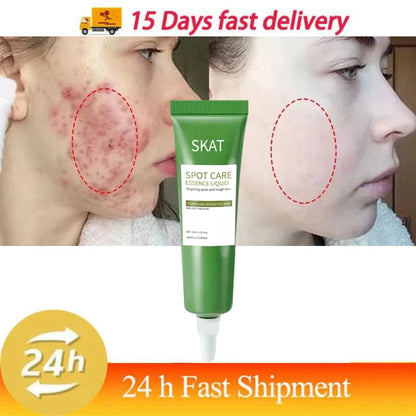 Zynerae Salicylic Acid Acne Cream – Pimple Spot and Scar Treatment.