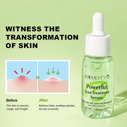 Acne Treatment Serum – Oil Control and Dark Spot Fading.
